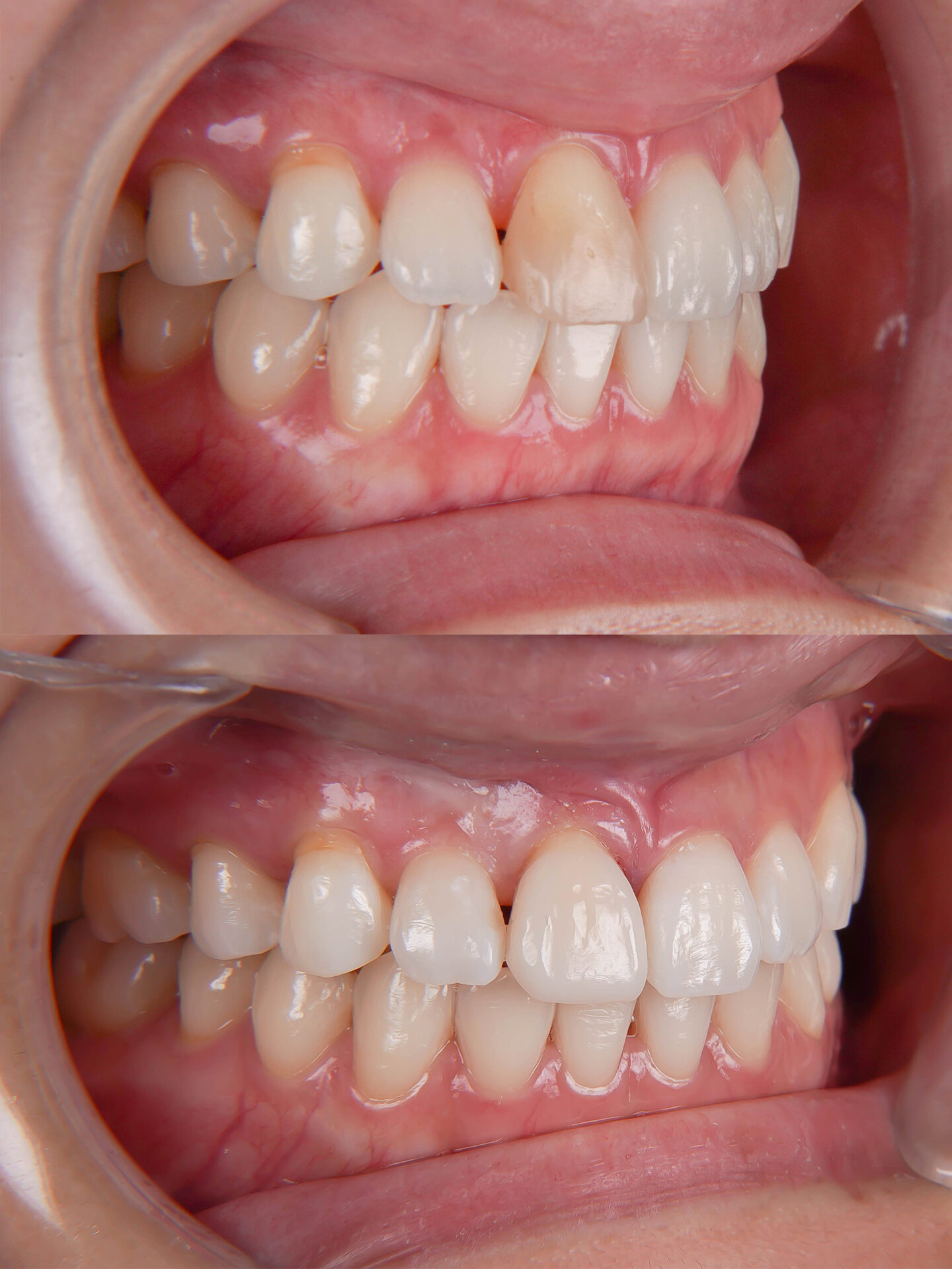 前歯が変色している状態に対してダイレクトボンディングにて対応した症例治療方法15